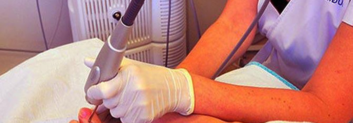 Лазерное лечение грибка ногтей  (ОНИХОМИКОЗ)